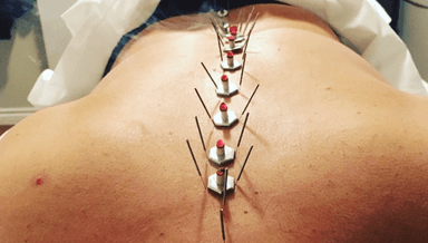 Image for Acupuncture Treatment 40 minutes